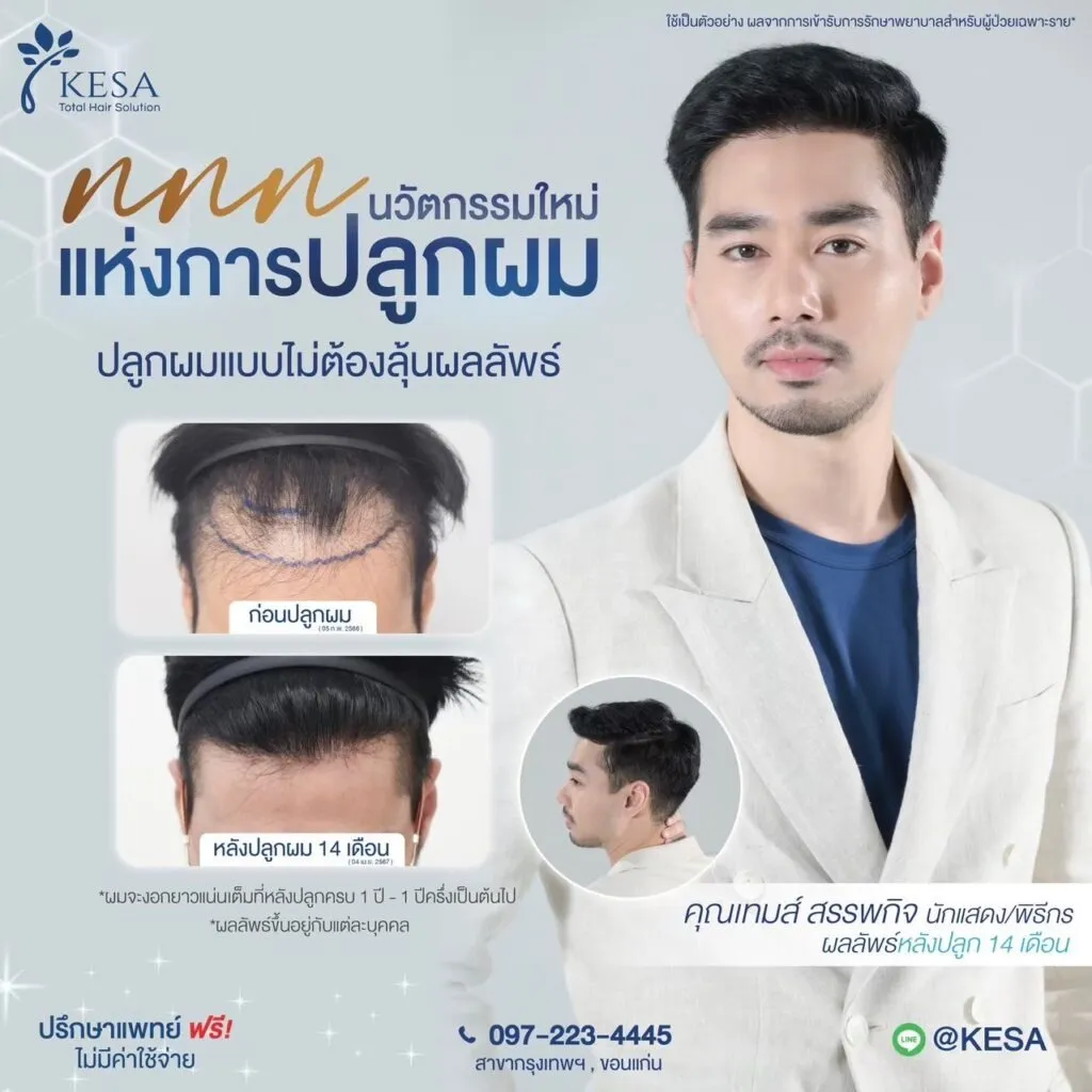 รีวิว ปลูกผม