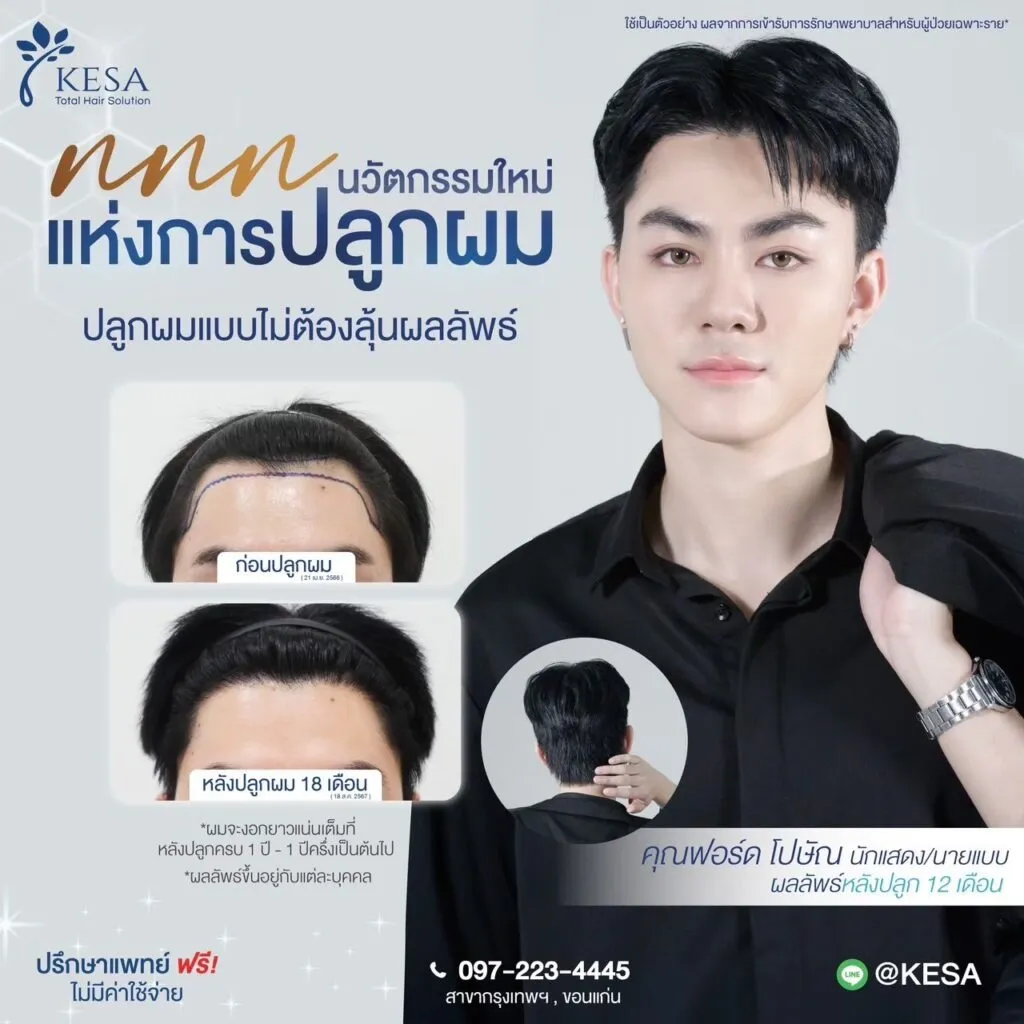 รีวิวปลูกผม