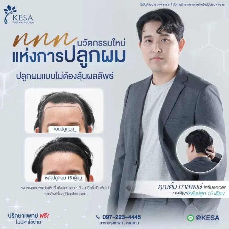 รีวิว ปลูกผม