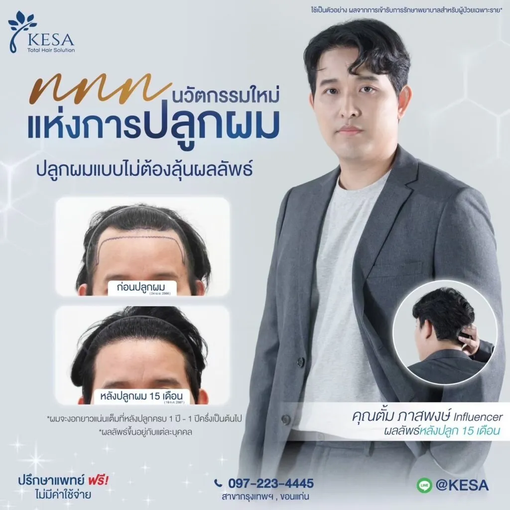 รีวิว ปลูกผม