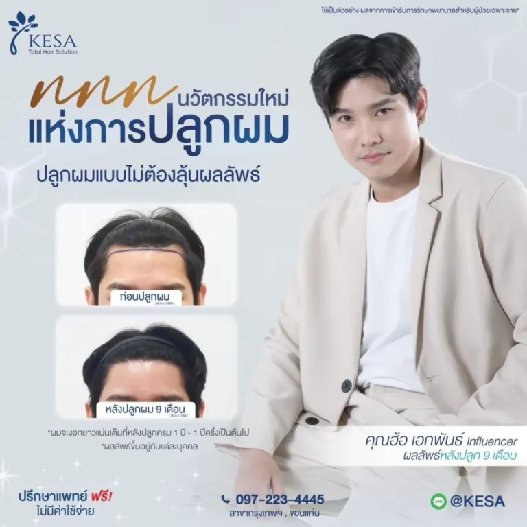 รีวิว ปลูกผม