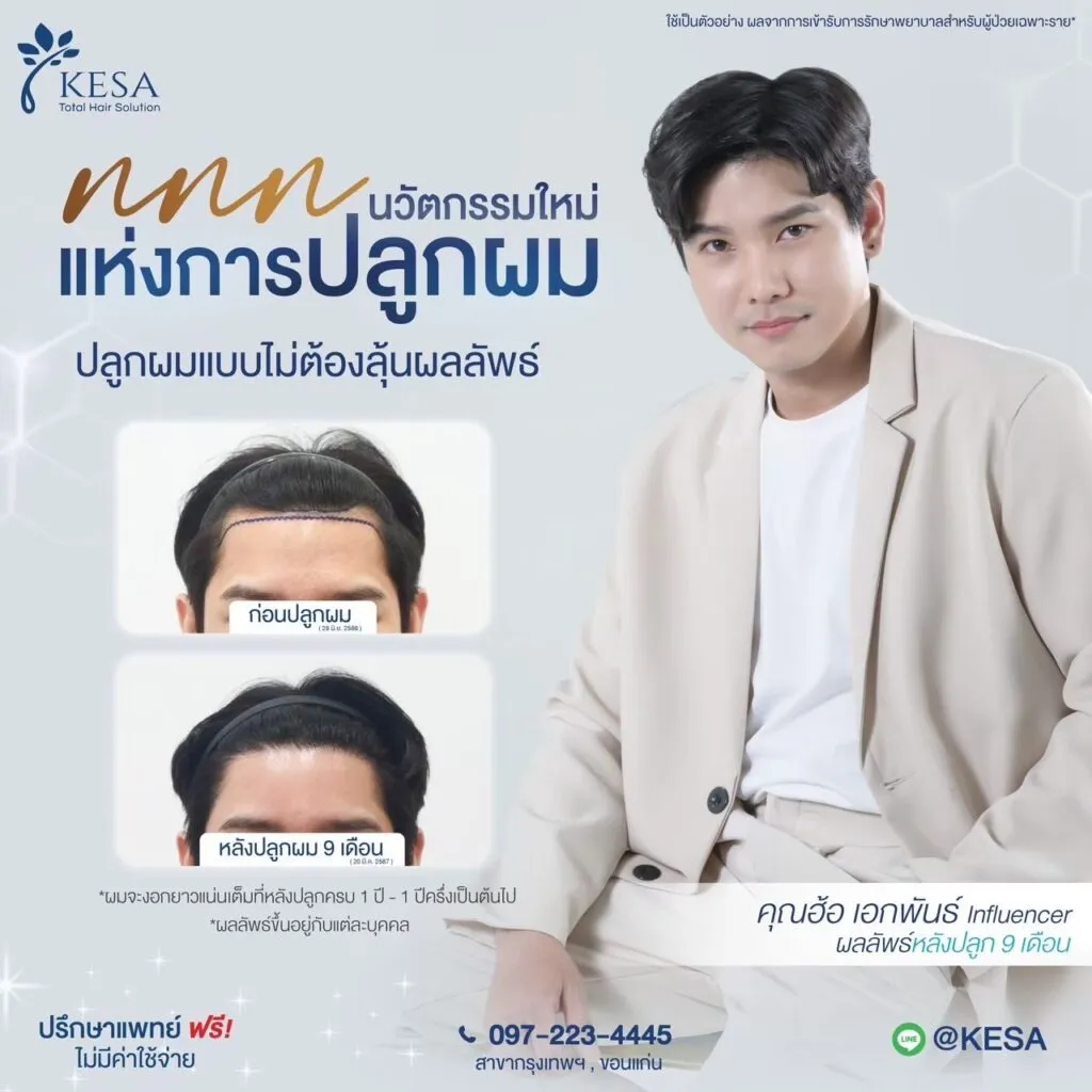 รีวิว ปลูกผม