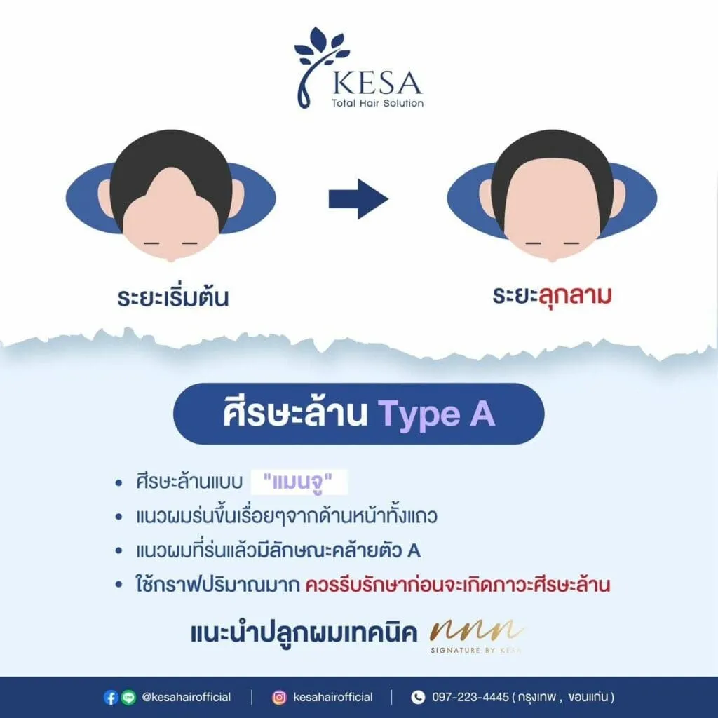 ศรีษะล้าน Tybe O