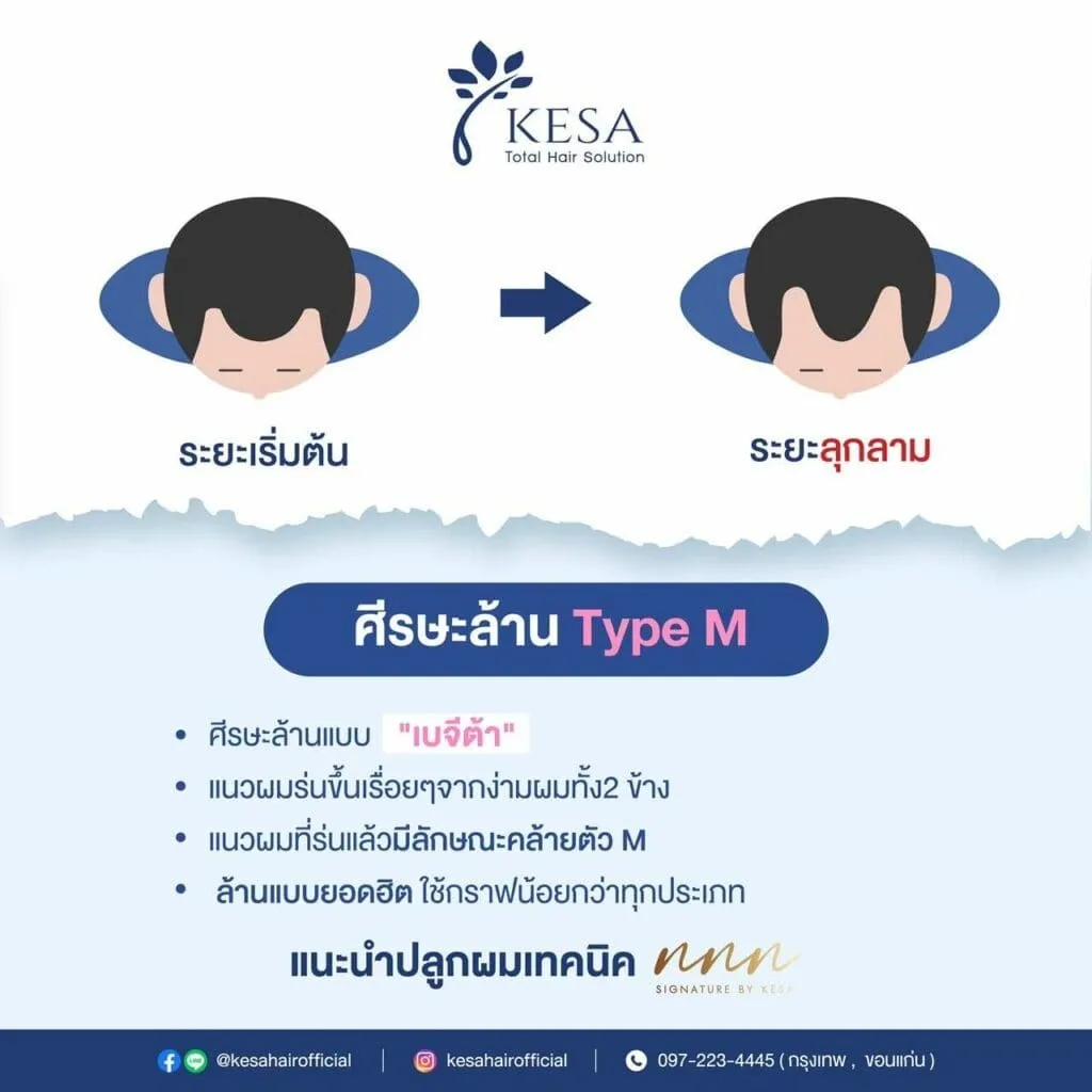 ศรีษะล้าน Tybe M