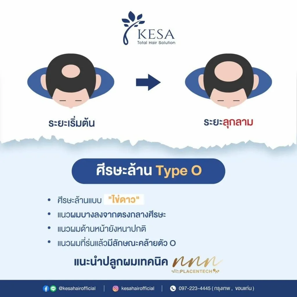 ศรีษะล้าน Tybe O