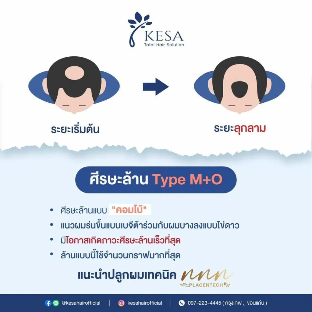 ศรีษะล้าน Tybe M + O