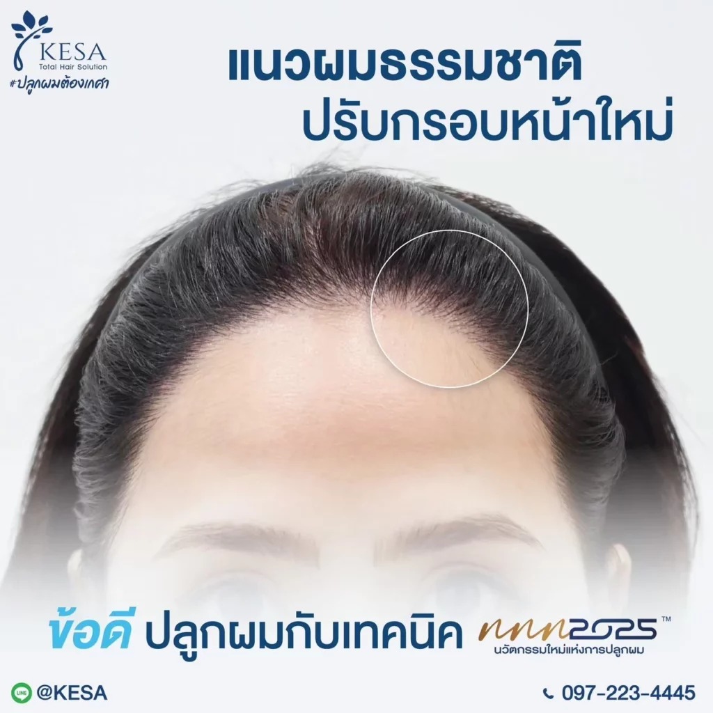 ปลูกผมผู้หญิง เกศา คลินิก - kesa hair clinic