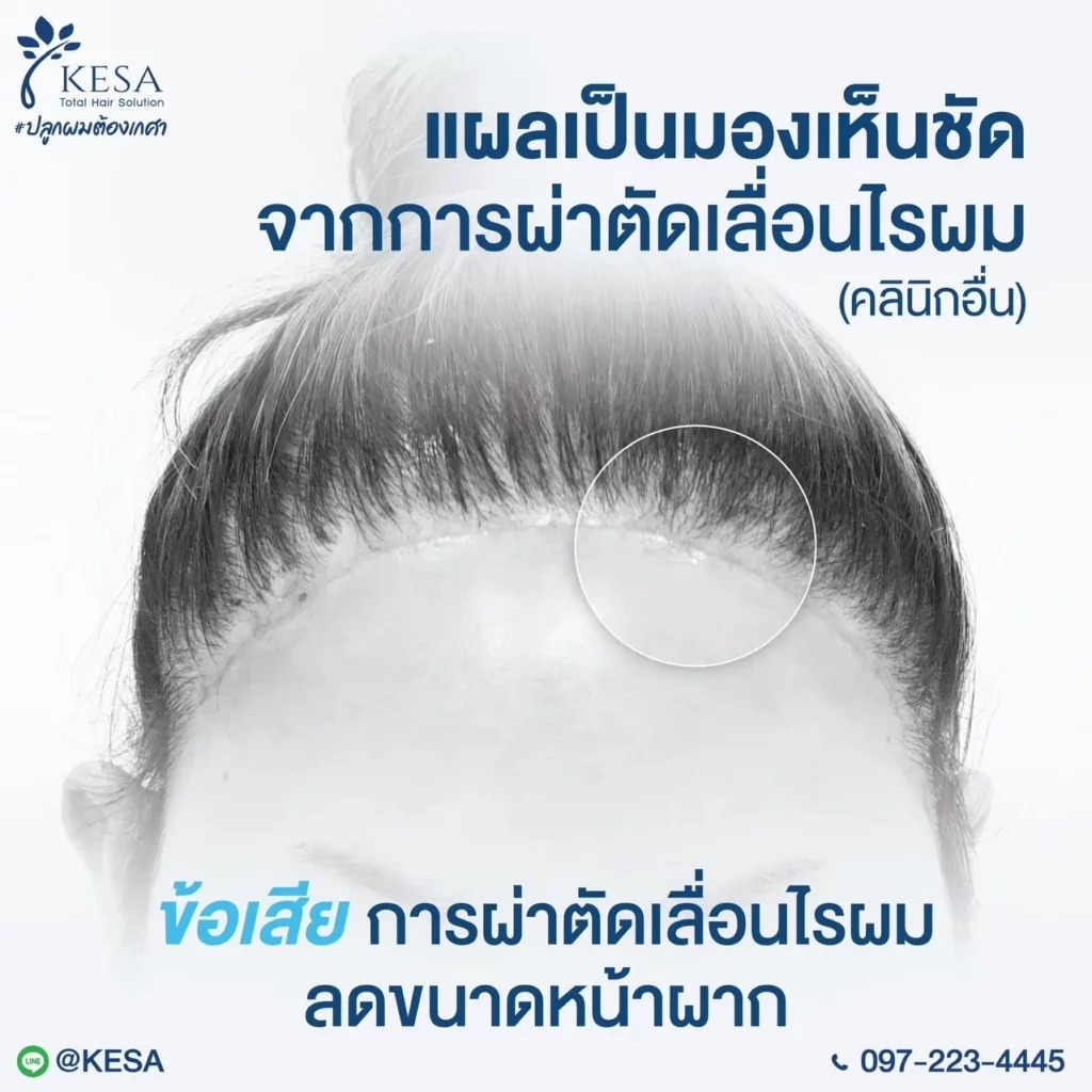 ผ่าตัดเลื่อนไรผม เกศา คลินิก - kesa hair clinic