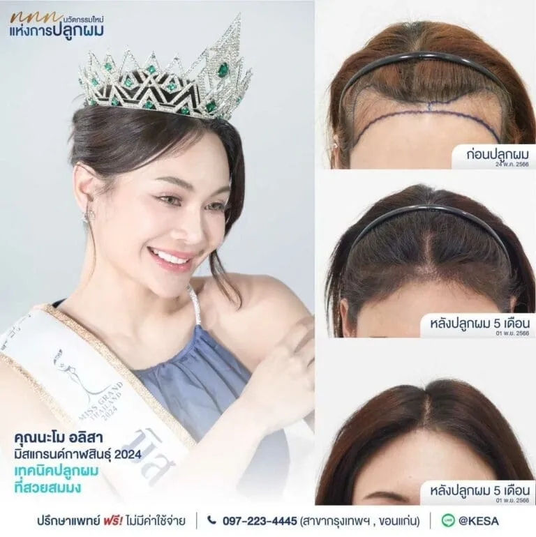 ปลูกผมแบบไม่ผ่าตัด เกศา คลินิก - kesa hair clinic