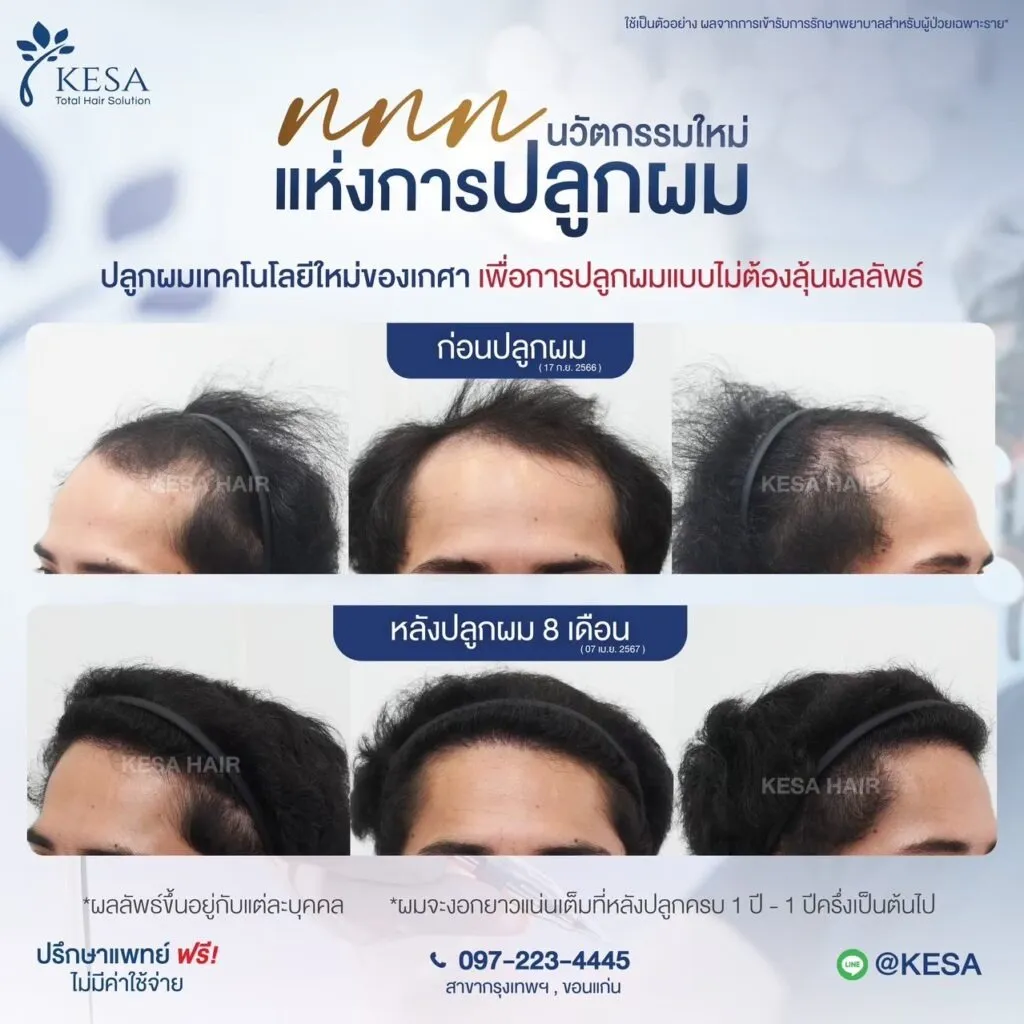 รีวิว ปลูกผม