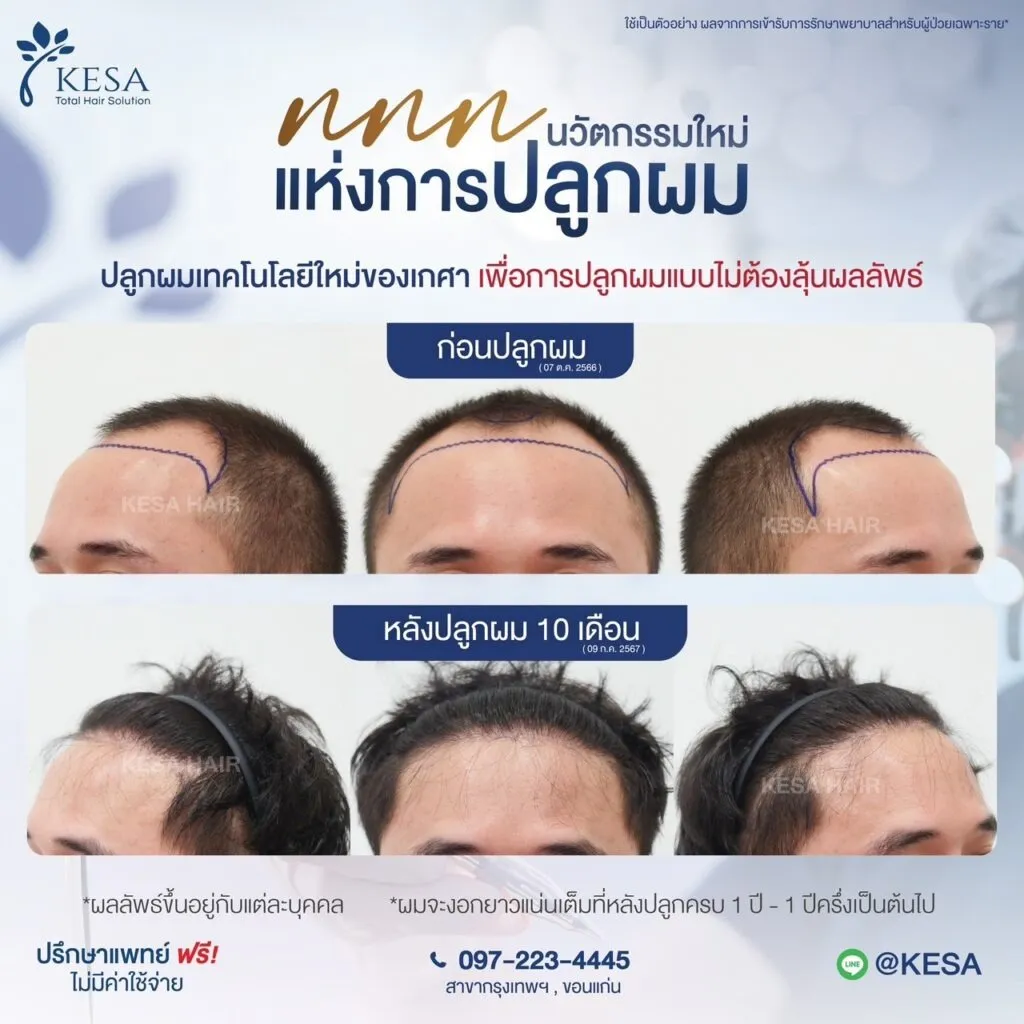 รีวิว ปลูกผม
