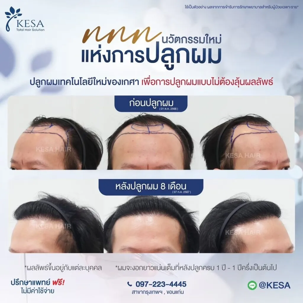 รีวิว ปลูกผม