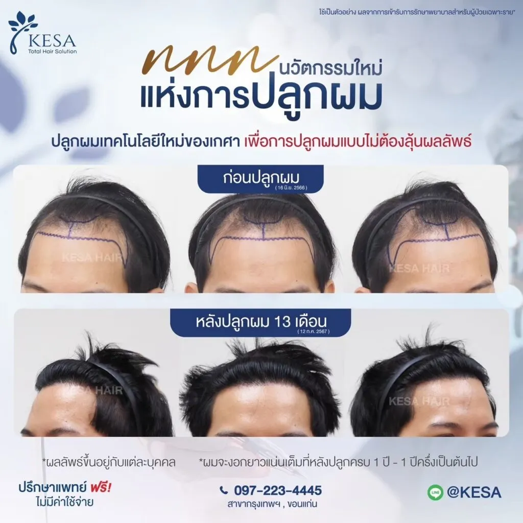รีวิว ปลูกผม