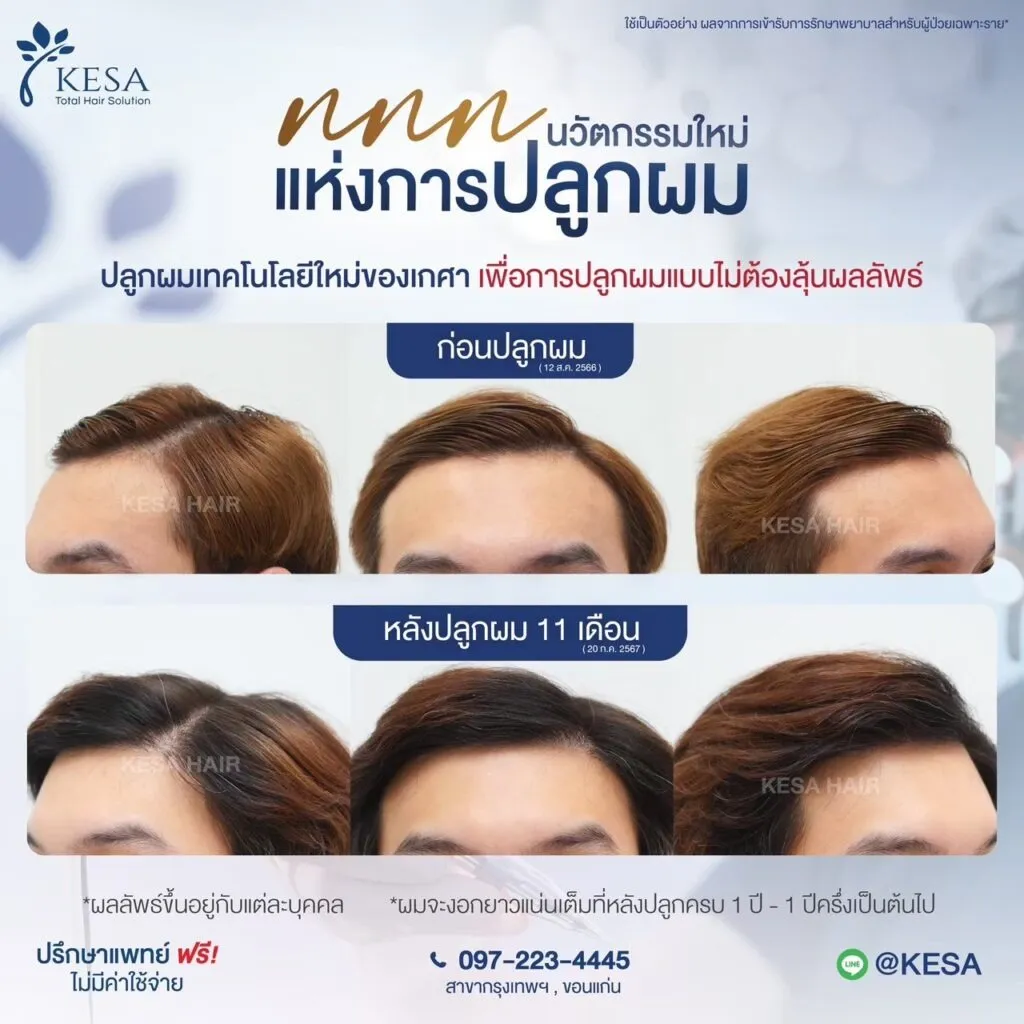 รีวิว ปลูกผม