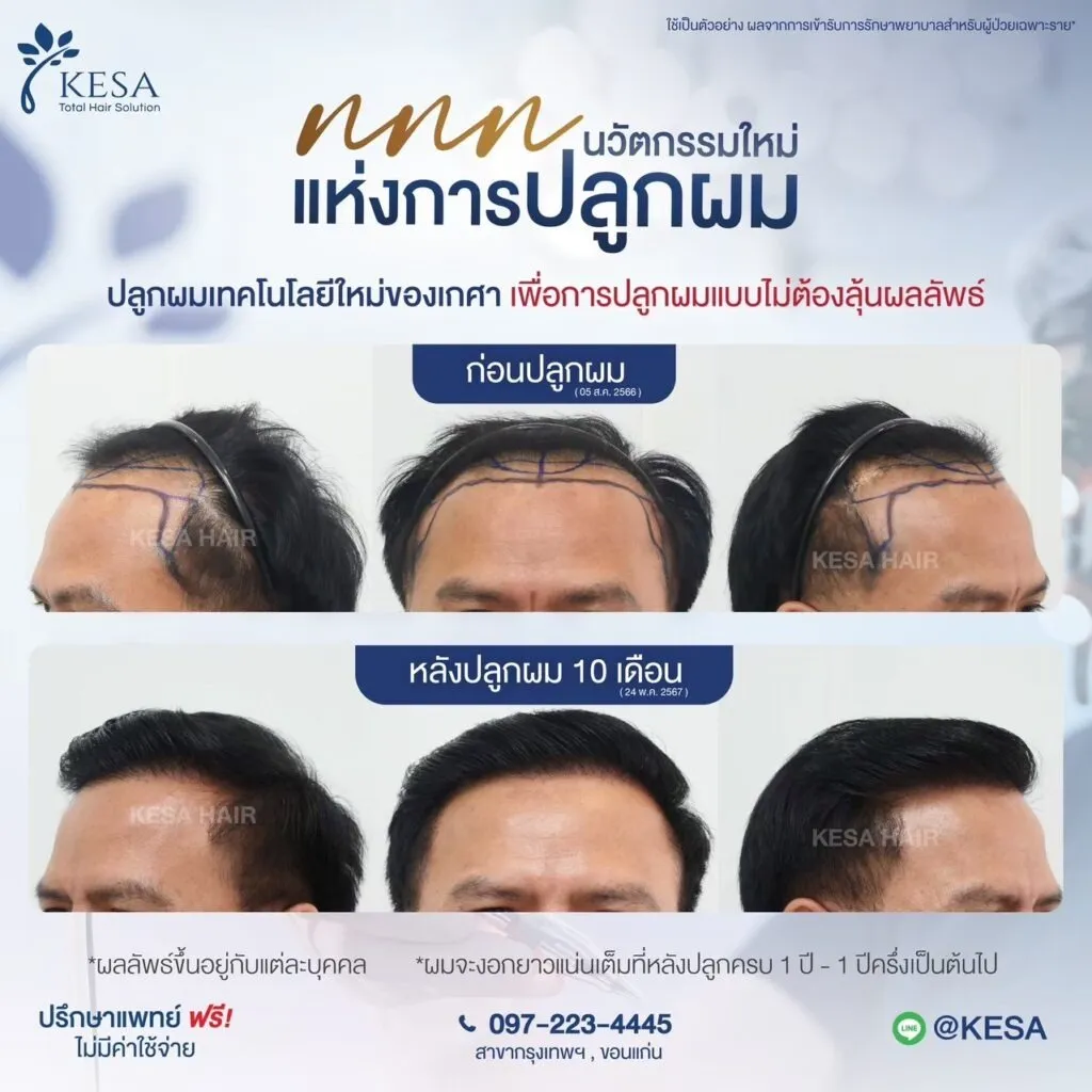 รีวิว ปลูกผม