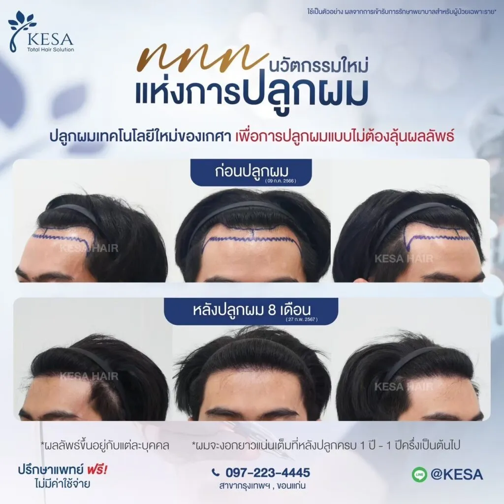 รีวิว ปลูกผม