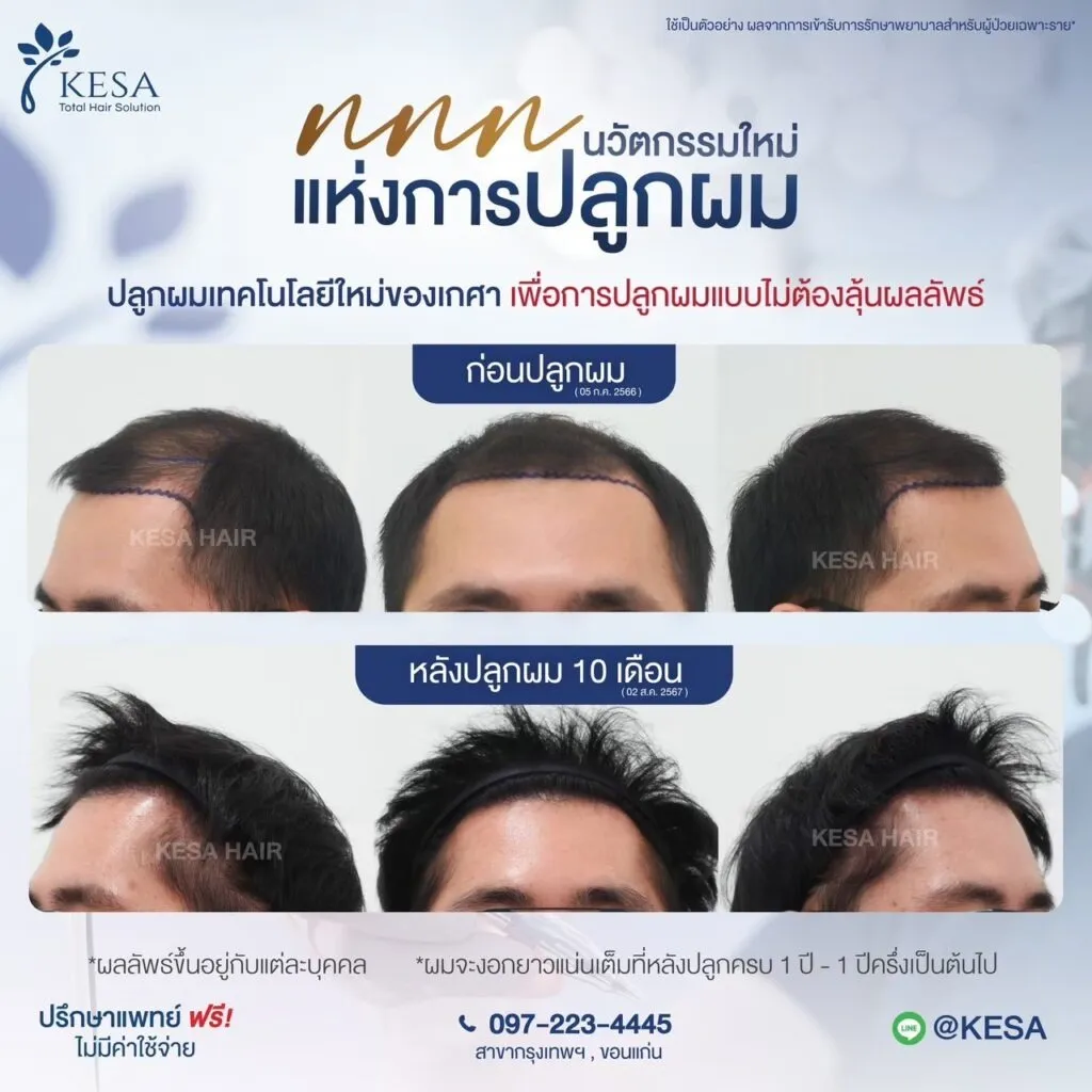 รีวิว ปลูกผม