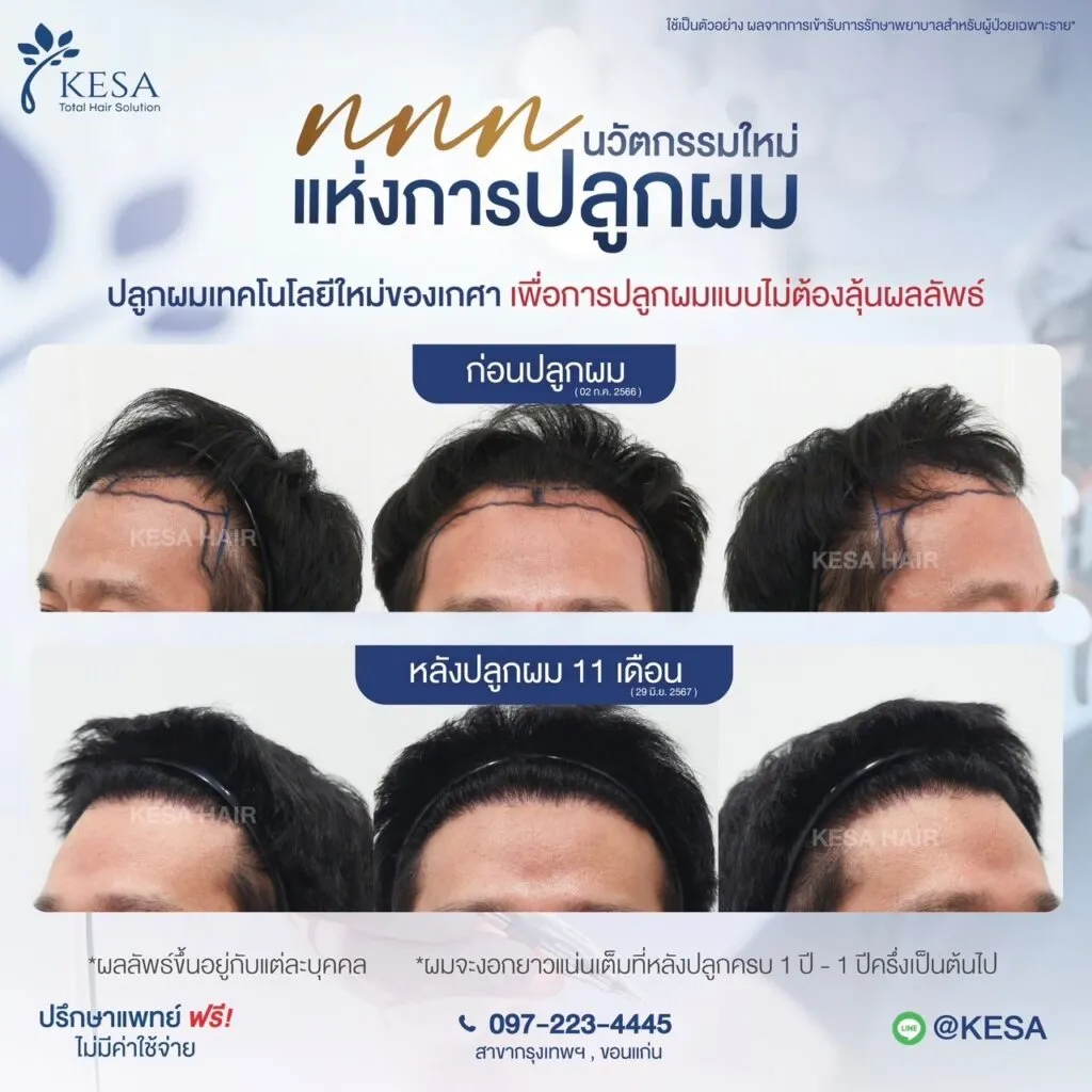 รีวิว ปลูกผม