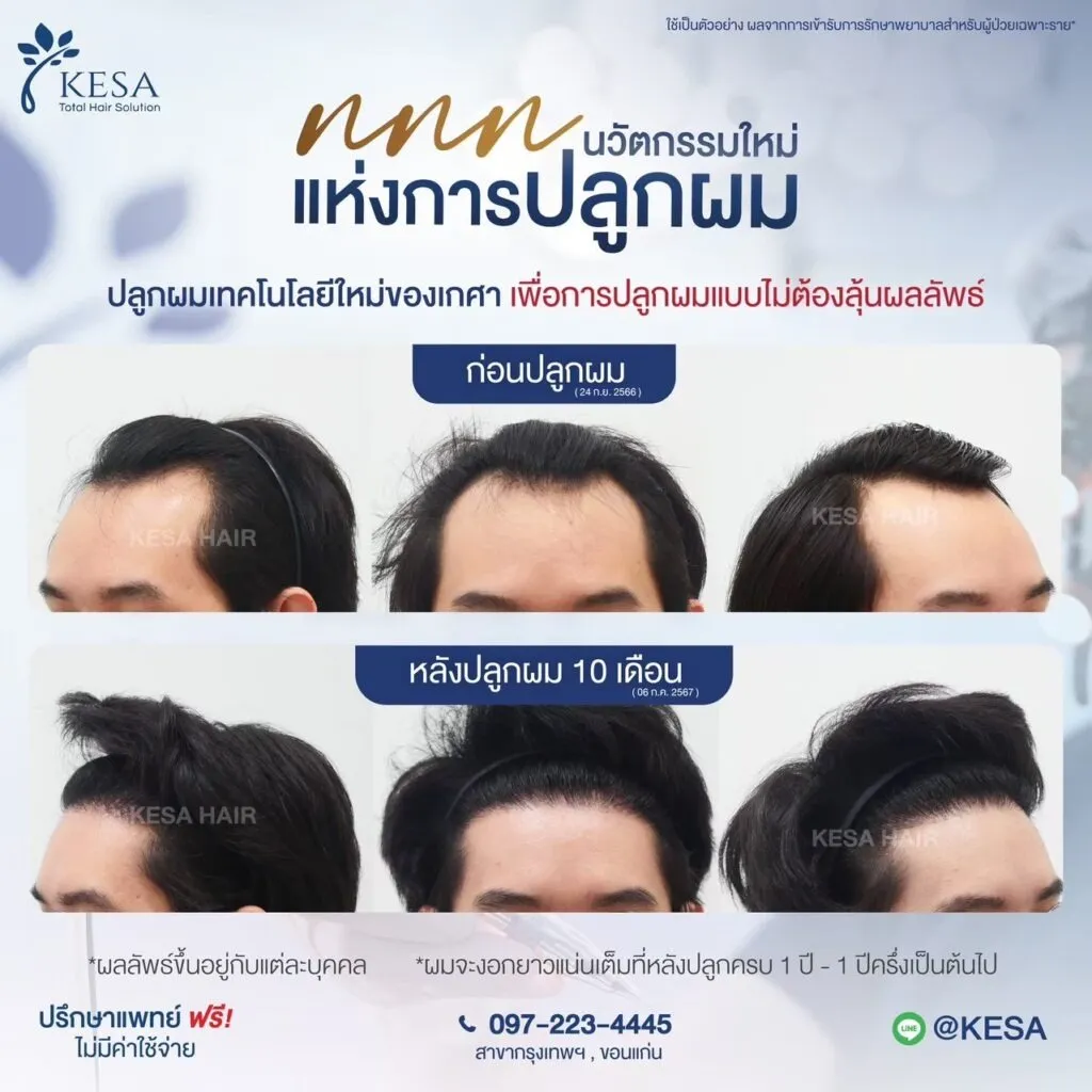 รีวิว ปลูกผม