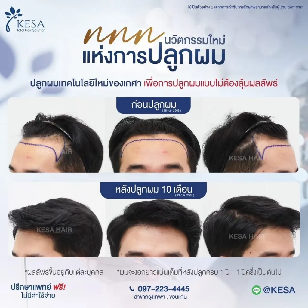 รีวิว ปลูกผม