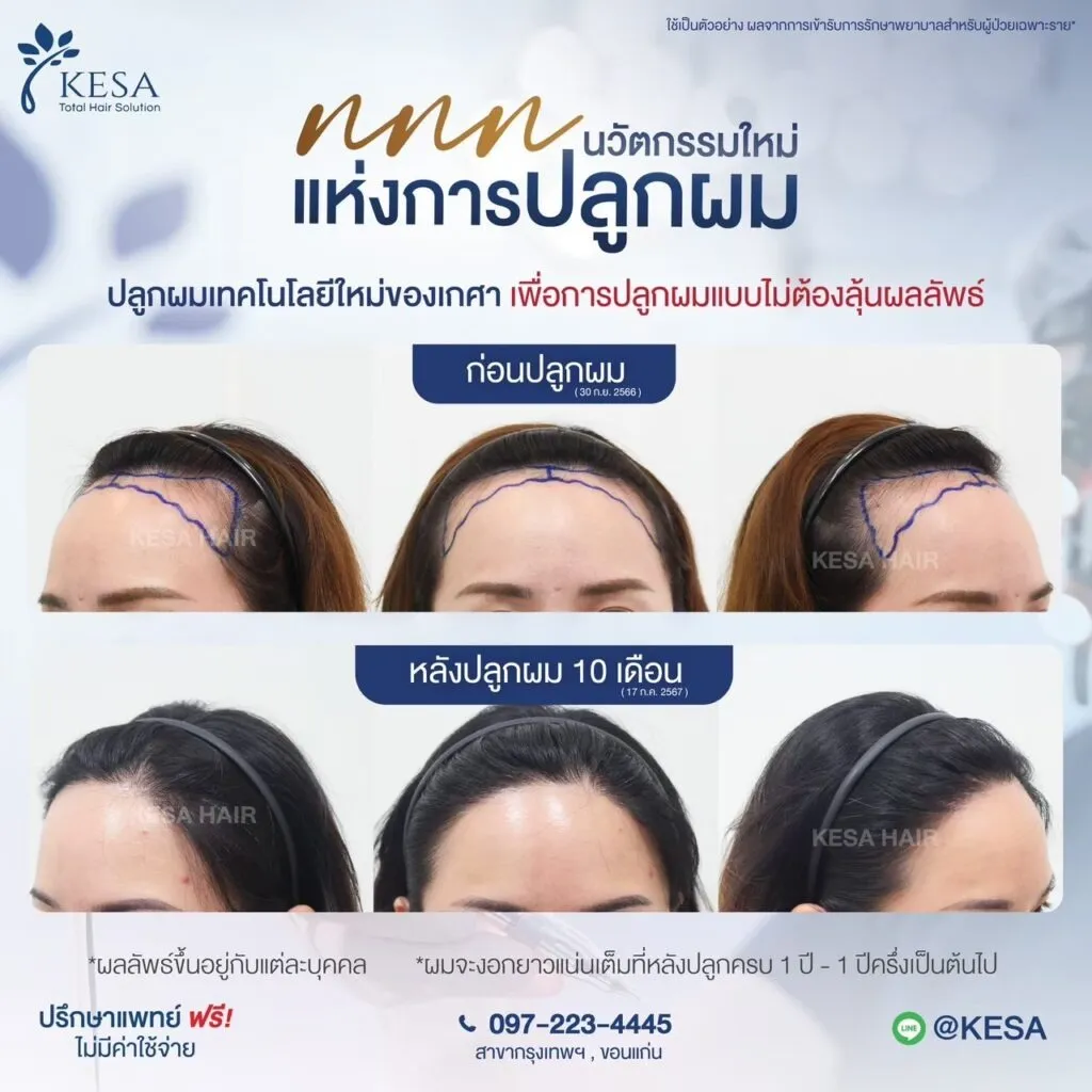 รีวิว ปลูกผม