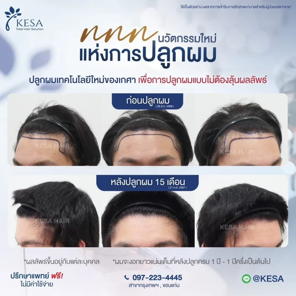 รีวิว ปลูกผม