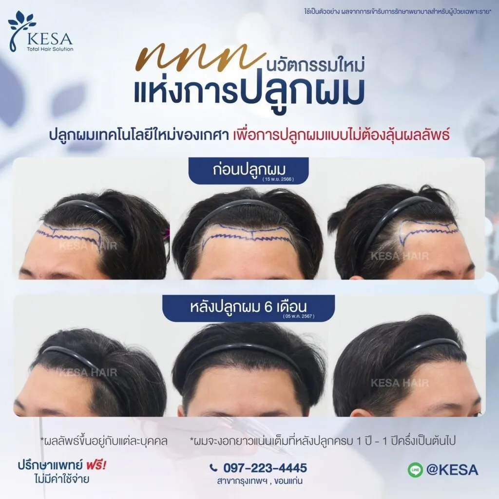 รีวิว ปลูกผม