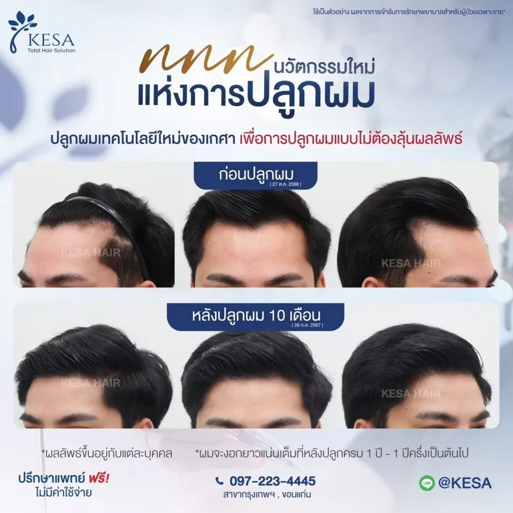 รีวิว ปลูกผม