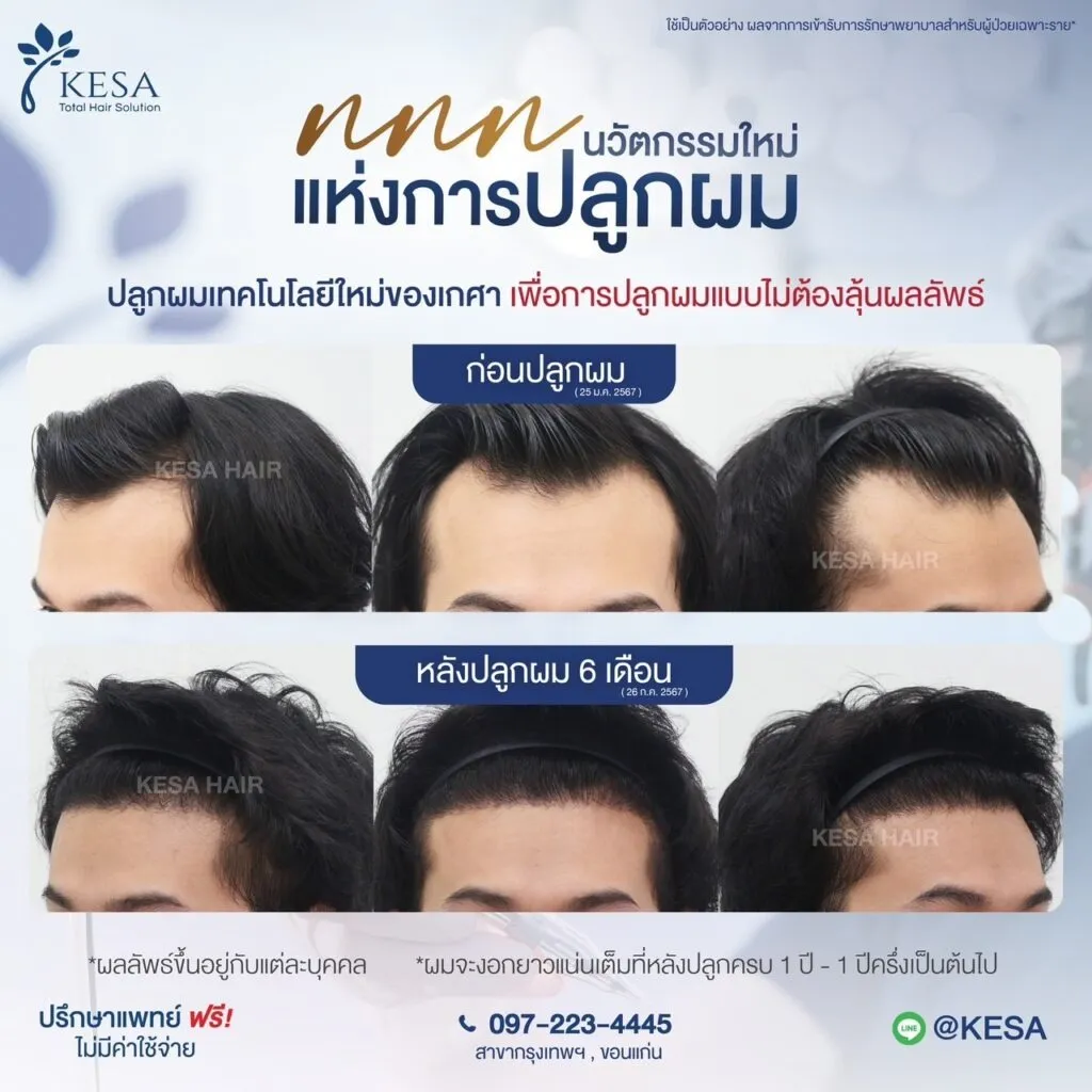 รีวิว ปลูกผม