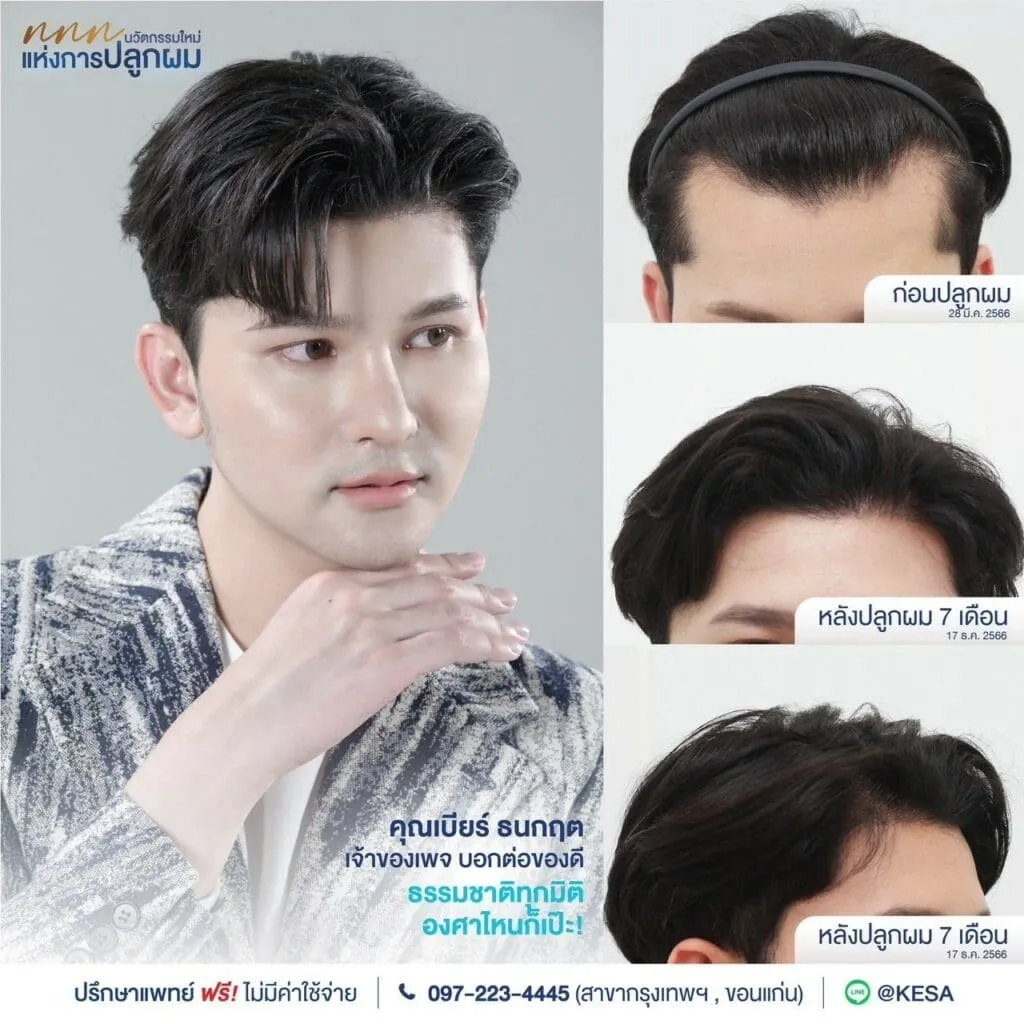 รีวิว ปลูกผม