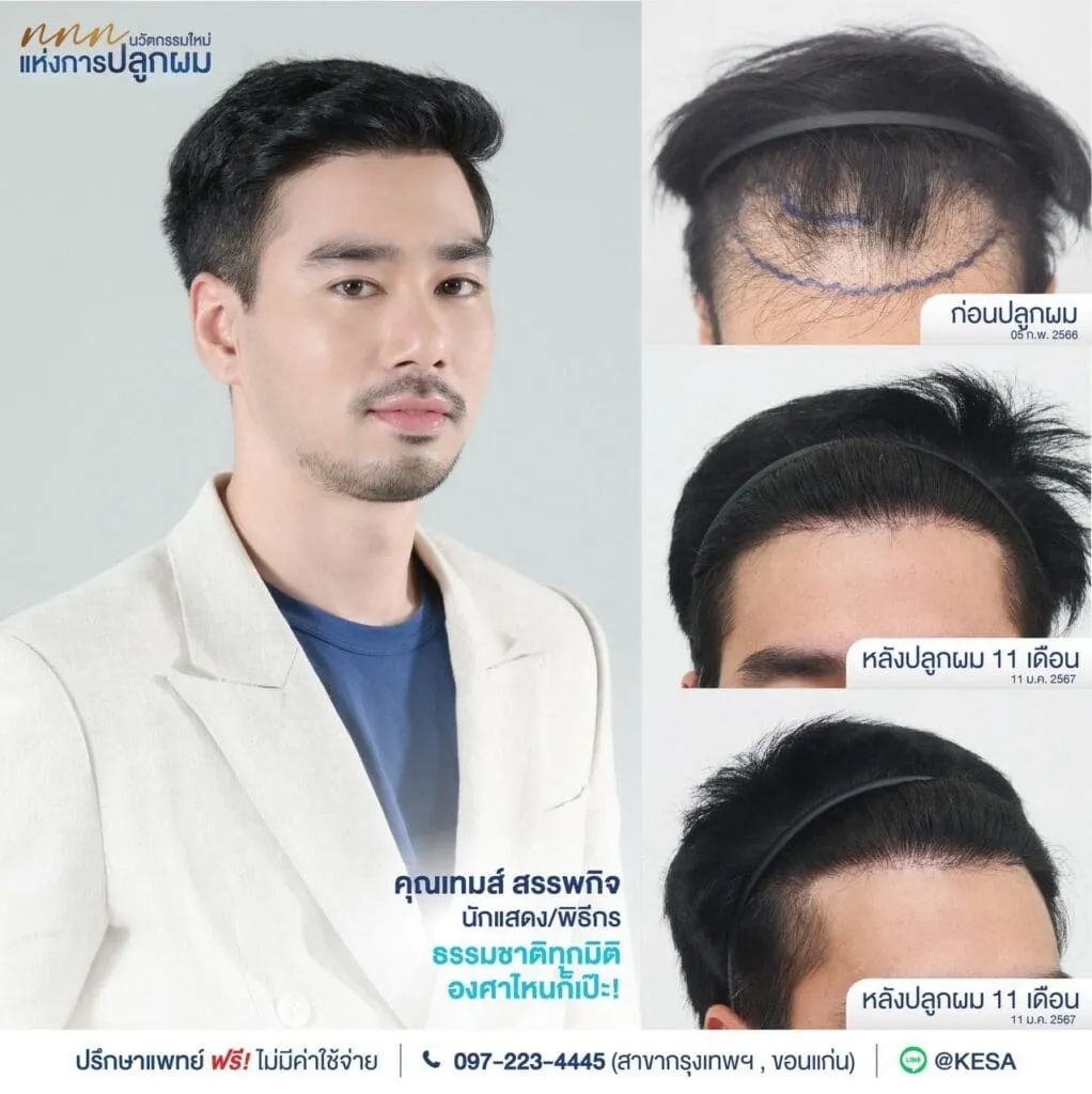 รีวิว ปลูกผม