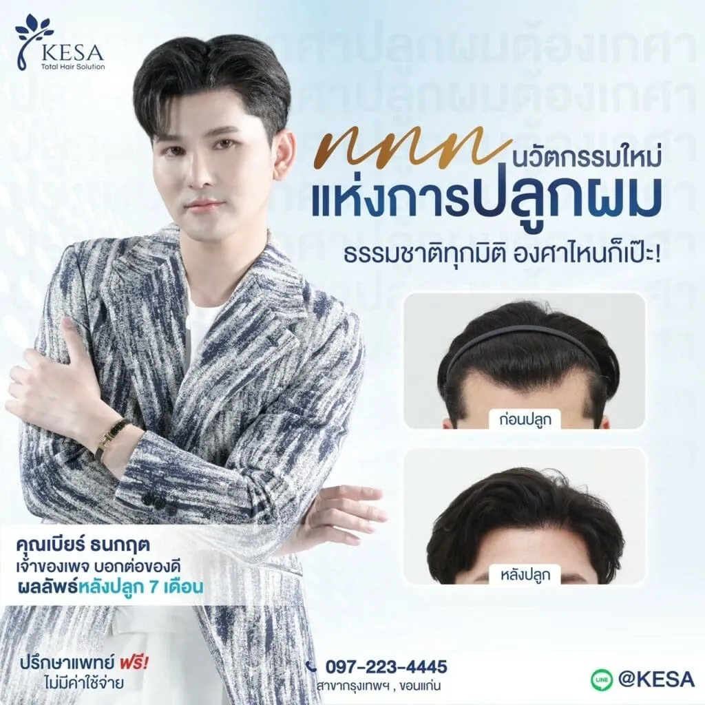 รีวิว ปลูกผม