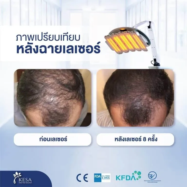 เลเซอร์กระตุ้นผม เกศา คลินิก - kesa hair clinic