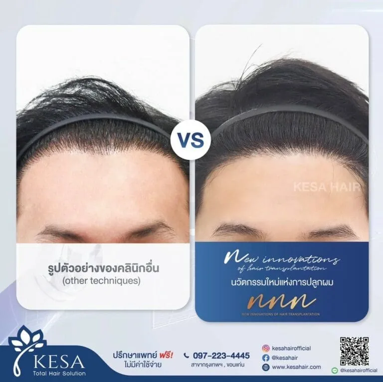 ปลูกผม NNN เกศา คลินิก - kesa hair clinic