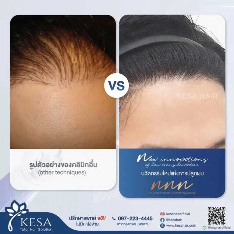 ปลูกผมแล้วไม่ขึ้น เกศา คลินิก - kesa hair clinic
