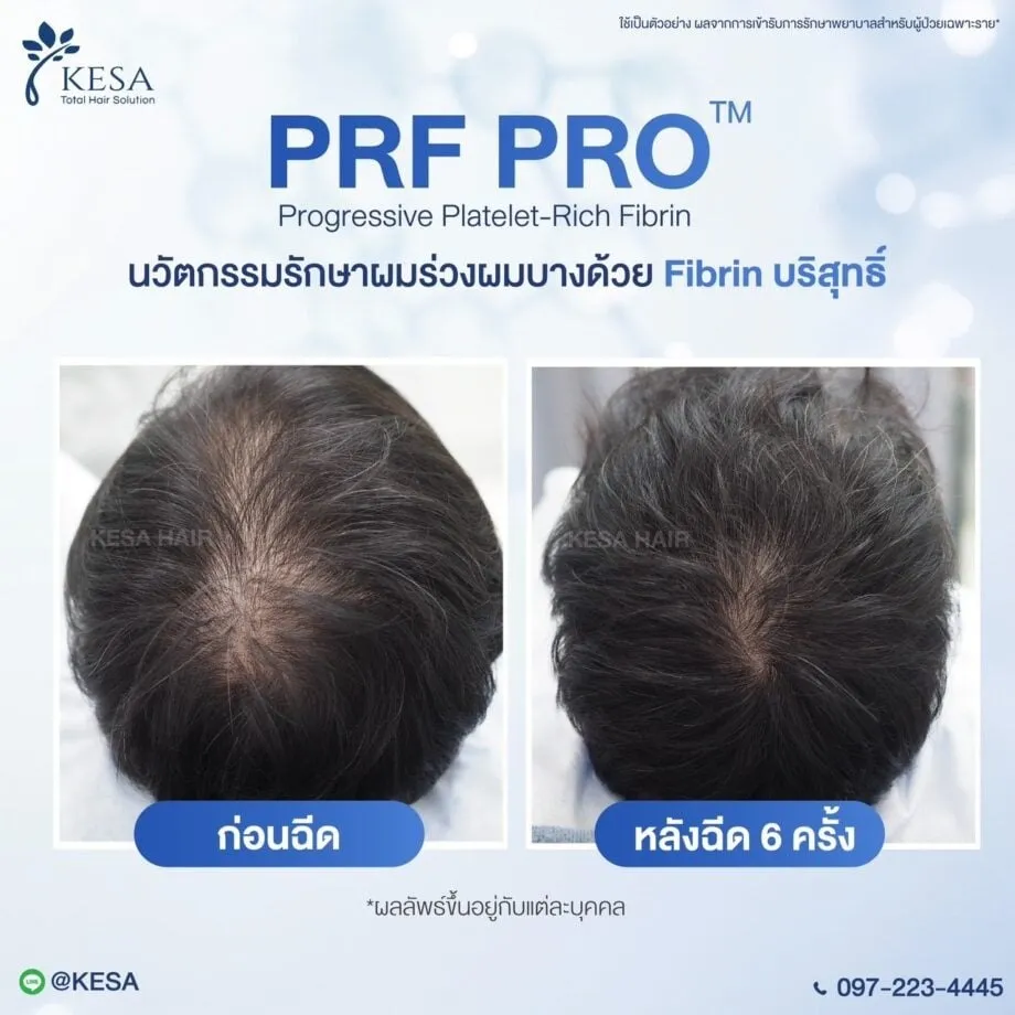 รักษาผมร่วงผมบาง