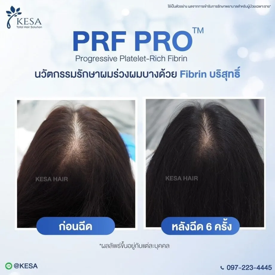 รักษาผมร่วงผมบาง