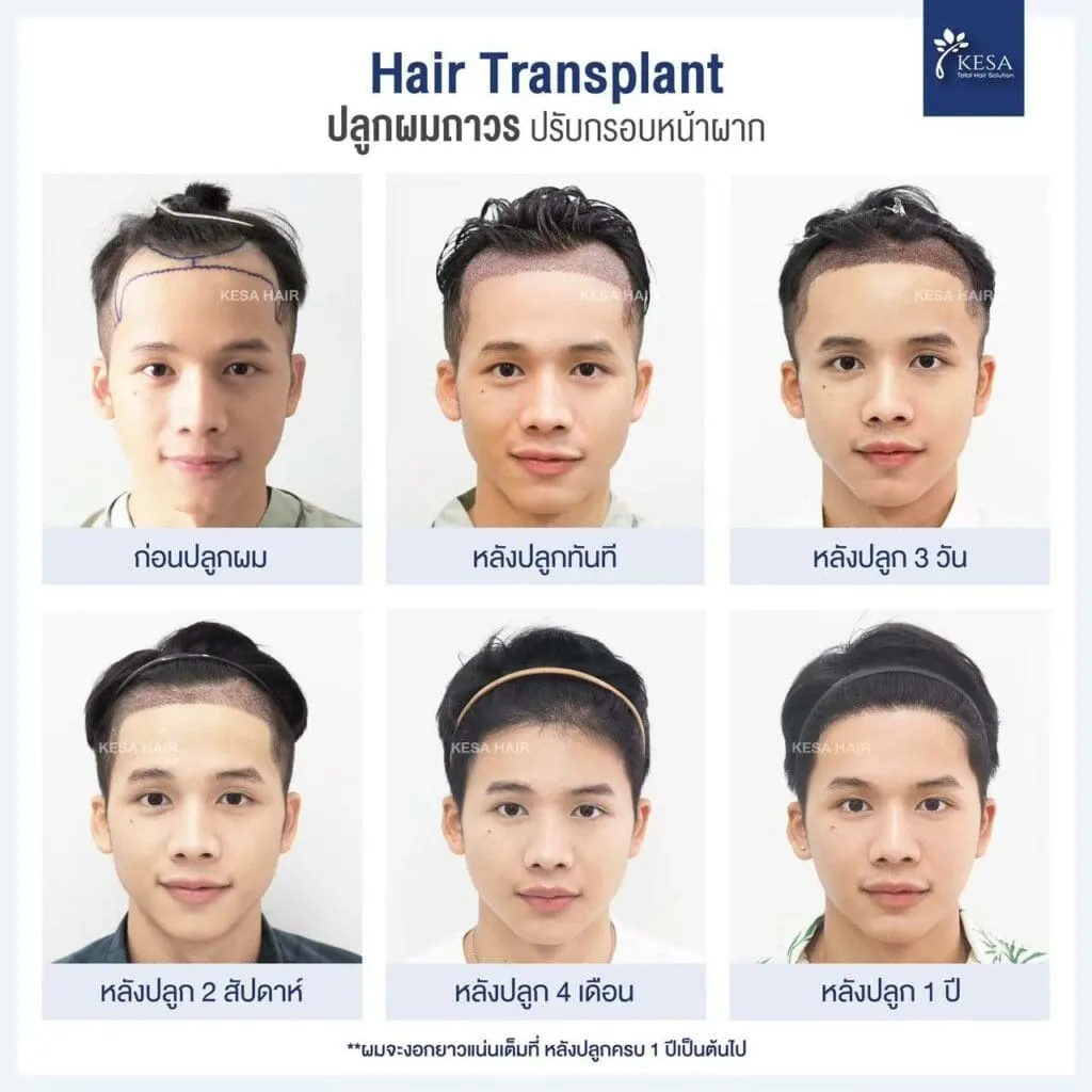 การเปลี่ยนแปลงหลังปลูกผม