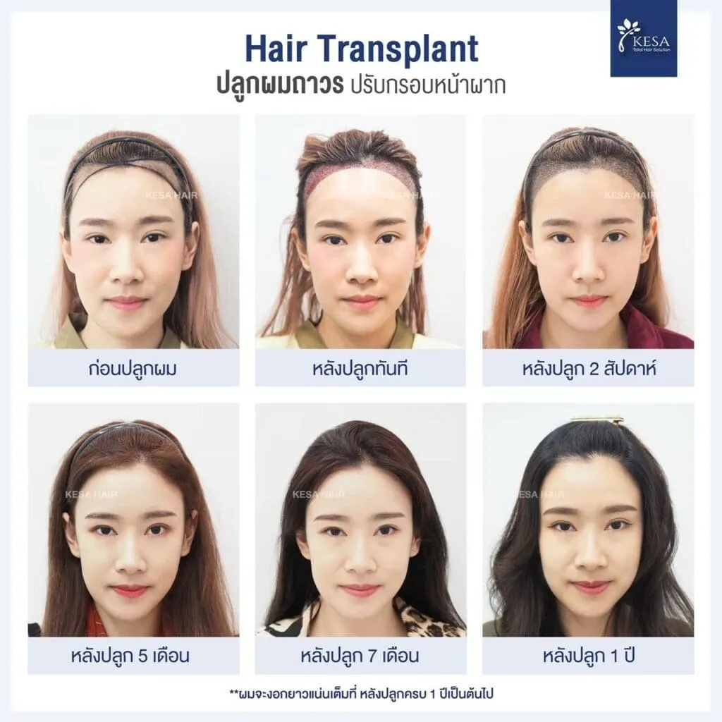 LINE_ALBUM_Review-set_๒๓๐๙๐๓_0-1024x1024 – เกศา คลินิก - kesa hair clinic ผลูกผมถาวร ปรับกรอบหน้าผาก