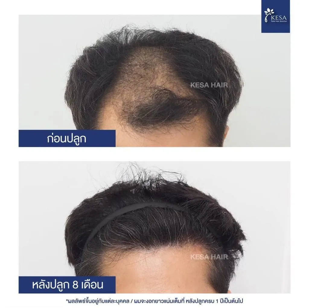 Review ปลูกผมที่เกศา