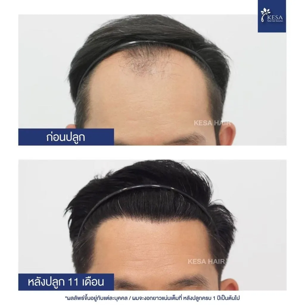 Review ปลูกผมที่เกศา