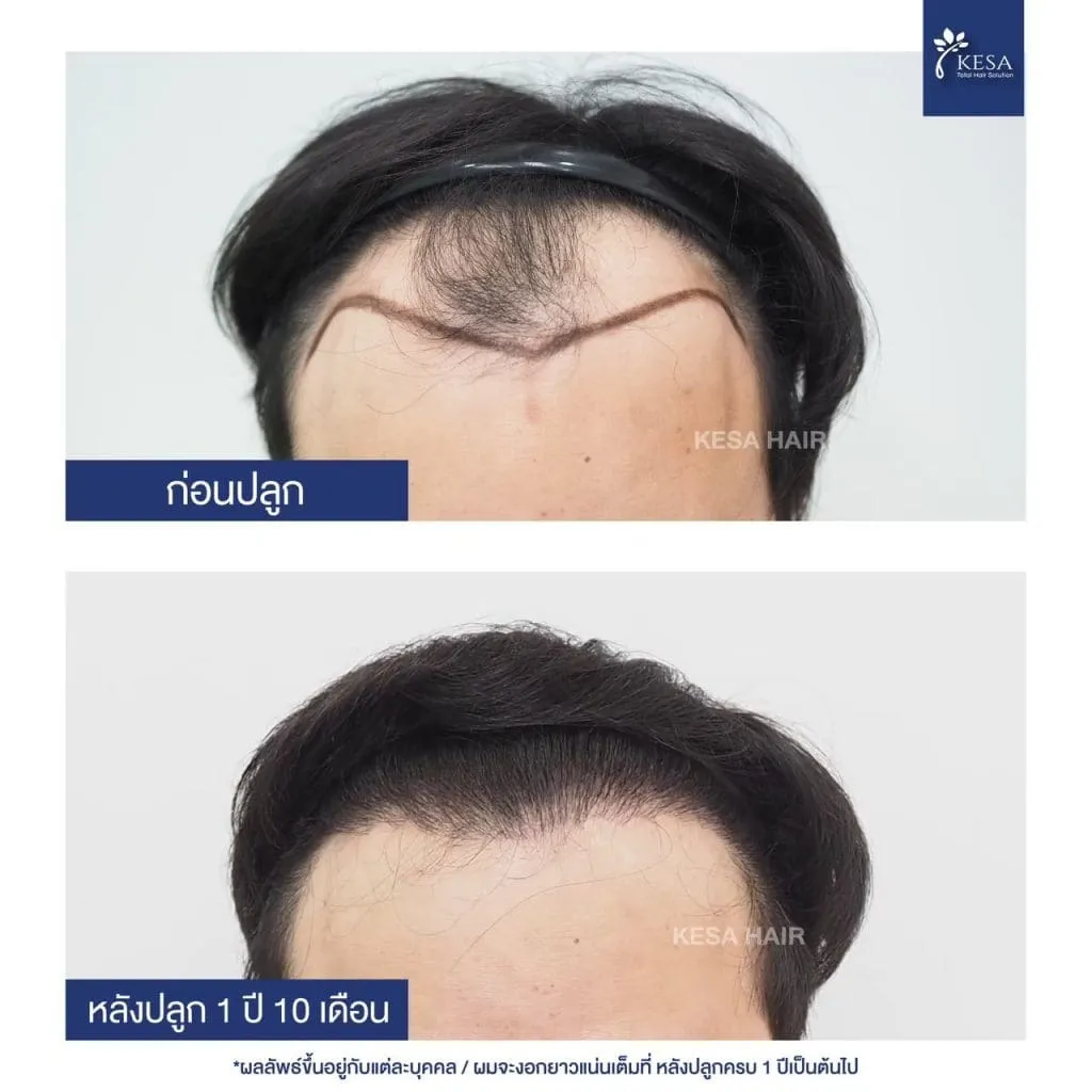 Review ปลูกผมที่เกศา