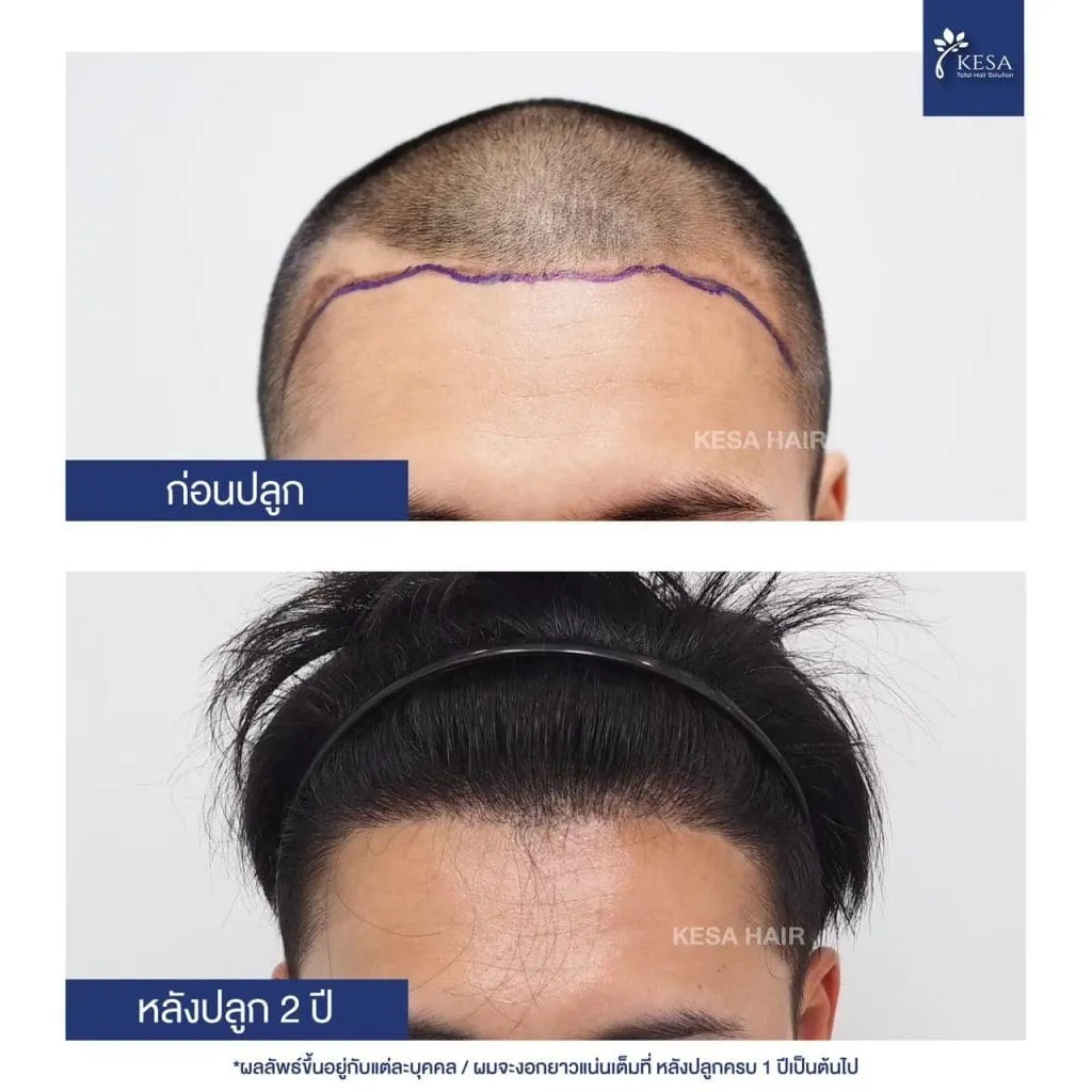 Review ปลูกผมที่เกศา