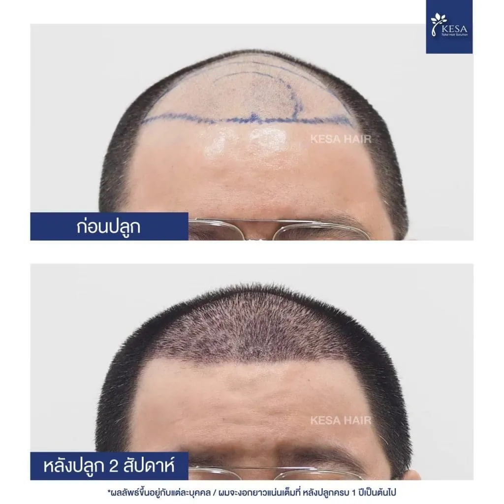 Review ปลูกผมที่เกศา