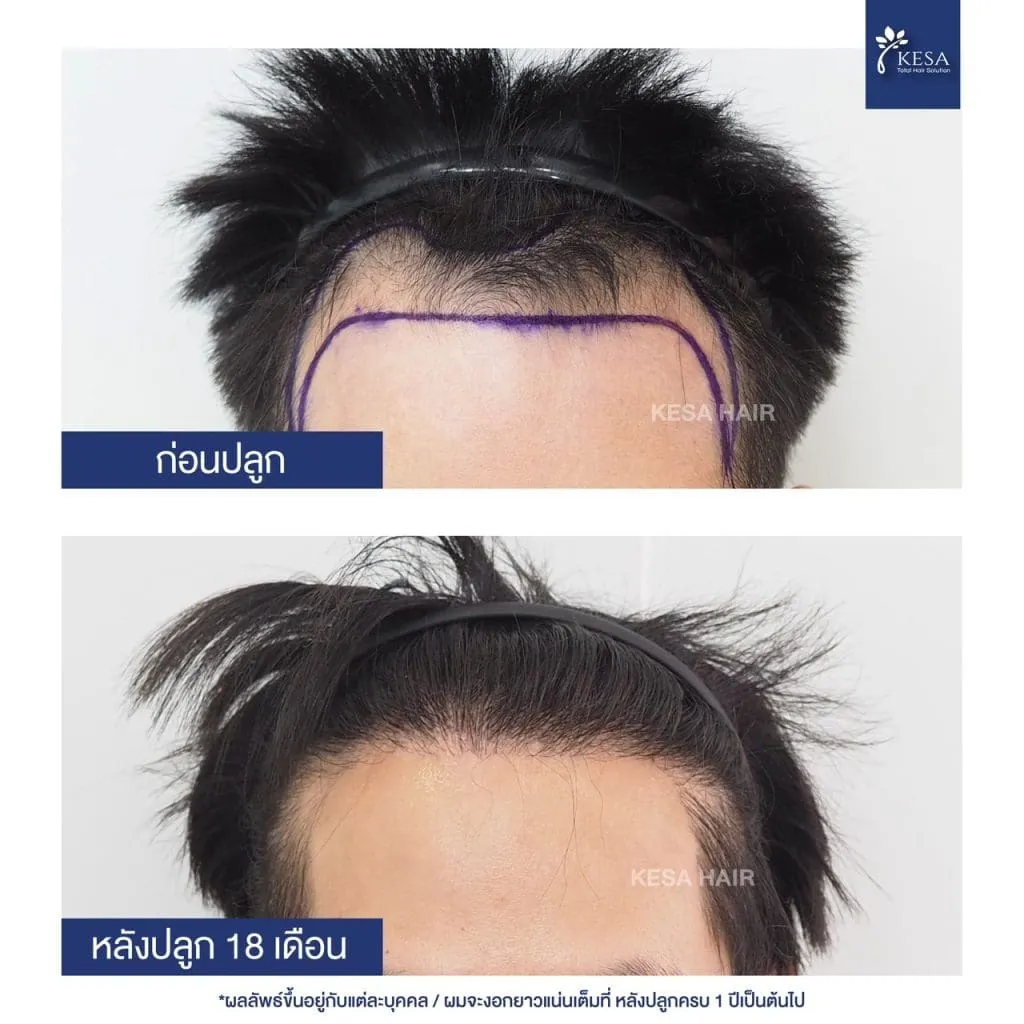 Review ปลูกผมที่เกศา