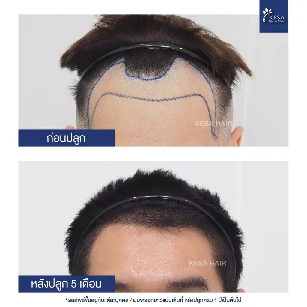 Review ปลูกผมที่เกศา