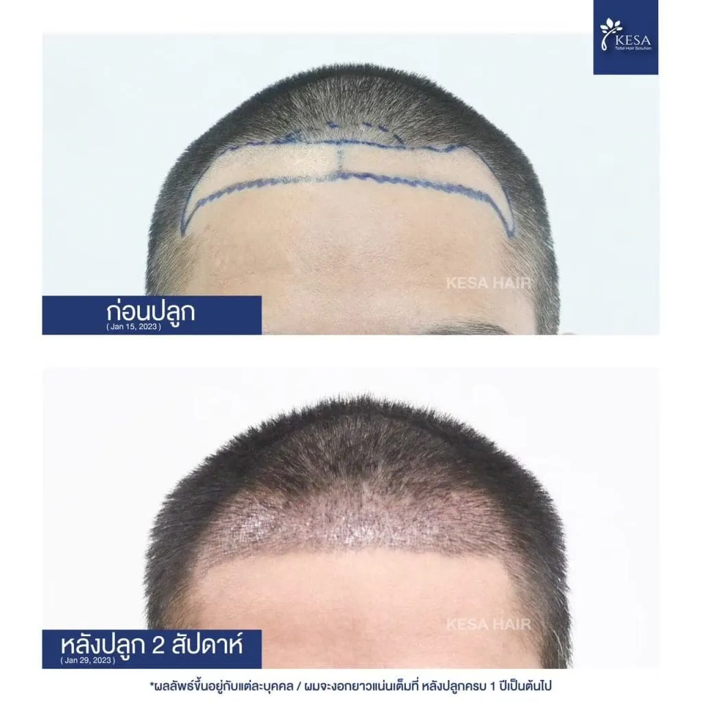 Review ปลูกผมที่เกศา