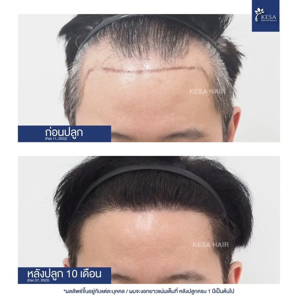 Review ปลูกผมที่เกศา