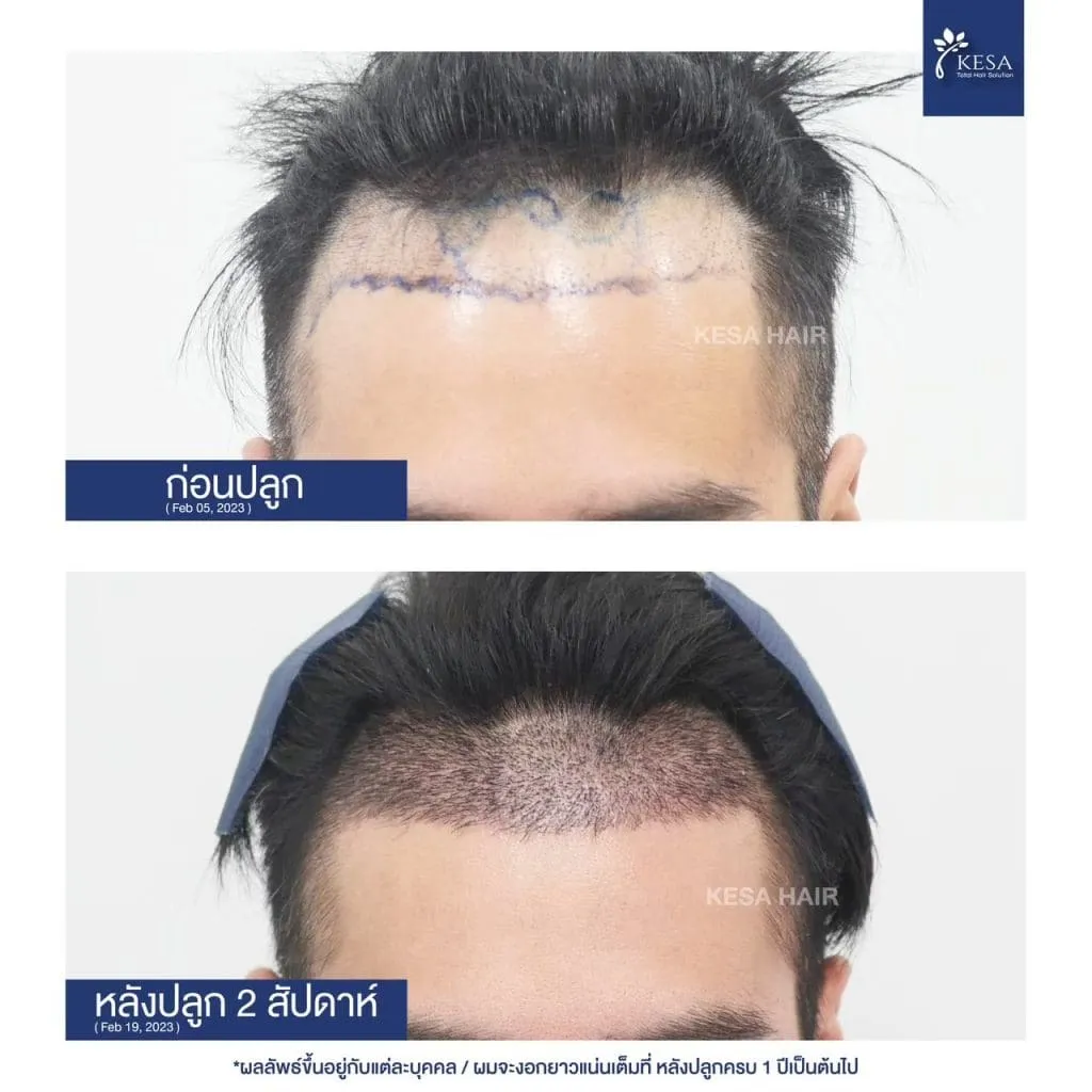 Review ปลูกผมที่เกศา