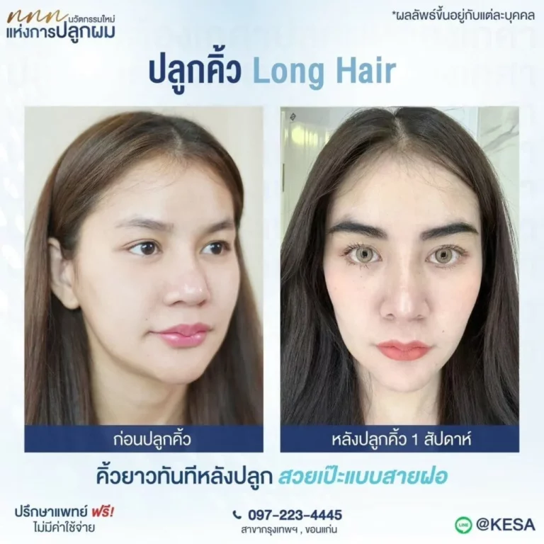 ปลูกคิ้ว Long Hair เกศา คลินิก - kesa hair clinic